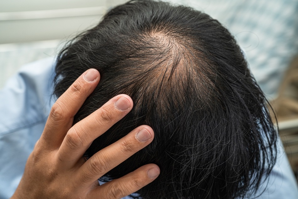Tình trạng rụng tóc bệnh lý là khi tóc rụng hơn 100 sợi mỗi ngày 