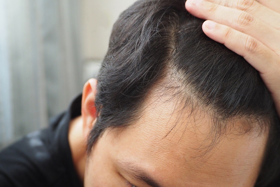 Vòng đời một sợi tóc ở nam giới thường trải qua 3 giai đoạn chính 