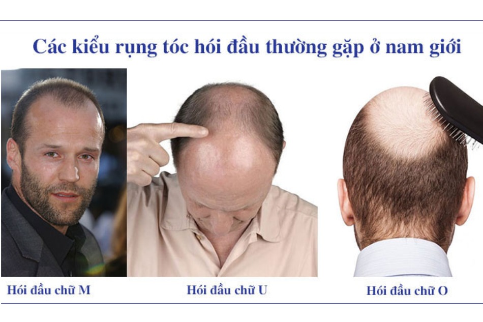 Có 3 kiểu rụng tóc nhiều ở nam giới được ghi nhận nhiều nhất 