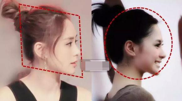 Minh họa sự phát triển xương chẩm kém ở trẻ sơ sinh dẫn đến đầu bẹt