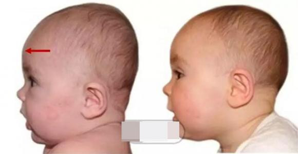 So sánh hình dáng hộp sọ giữa người có đầu bẹt và đầu tròn