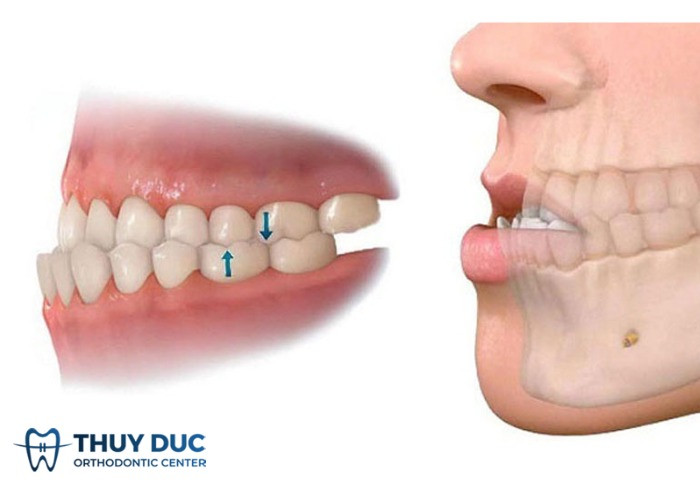 Khớp cắn ngược là nguyên nhân phổ biến gây ra khuôn mặt lưỡi cày