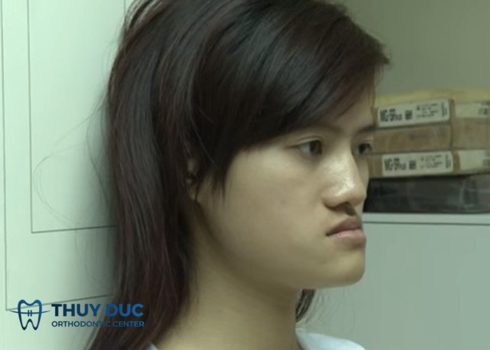 Khuôn mặt lưỡi cày thường thiếu cân đối và hài hòa