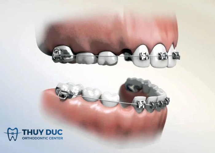 Niềng răng giúp điều chỉnh khớp cắn ngược cho khuôn mặt lưỡi cày