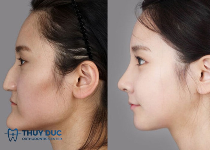 Phẫu thuật thẩm mỹ giúp cải thiện hình dáng xương hàm cho khuôn mặt lưỡi cày